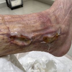 Moon Charles, MD - Cedars-Sinai Medical Center - Infection in progress