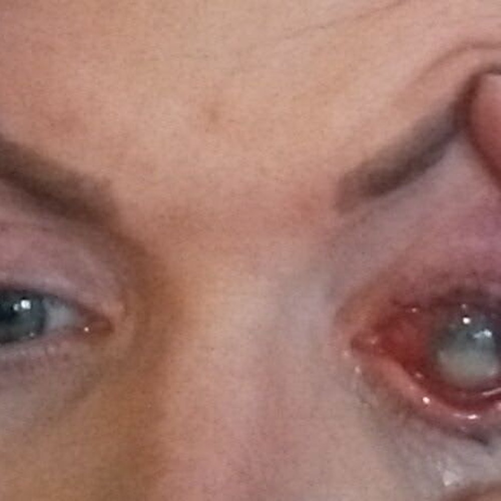 Boston Eye Group - Fungal infection from ptosis repair??? - Optometrists Near Me - Milford, Massachusetts Boston Eye Group - Fungal infection from ptosis repair??? - Optometrists Near Me - Milford, Massachusetts