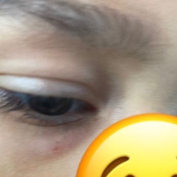 KidsPark - Scratch under eye, his under eye was bruised and purple looked worst the day after - no ouch report was sent home. No ouch report sent home - Child Care & Day Care Near Me - San Jose, California KidsPark - Scratch under eye, his under eye was bruised and purple looked worst the day after - no ouch report was sent home. No ouch report sent home - Child Care & Day Care Near Me - San Jose, California