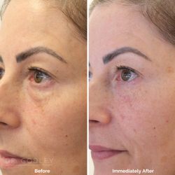 Godley Clinic - Under eye thread lift to address eye bags.