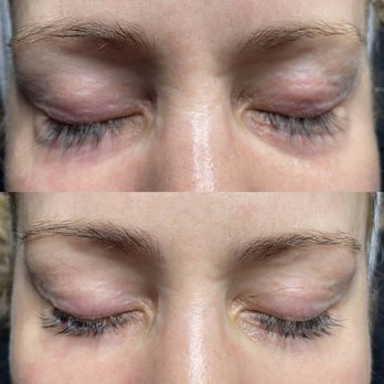 Evolve Aesthetics - Lifted lashes, reduced puffiness with Nanofusion, lash lift, lash tint and brow wax. - Skin Care Near Me - Reno, Nevada