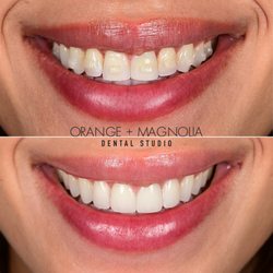 Orange and Magnolia Dental Studio - Before and after smile makeover with 4 porcelain veneers following Invisalign by Dr. Joyce Kahng in Orange County, CA.