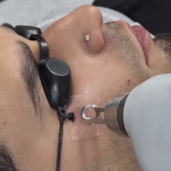 Goscalp (Laser Tattoo Removal)