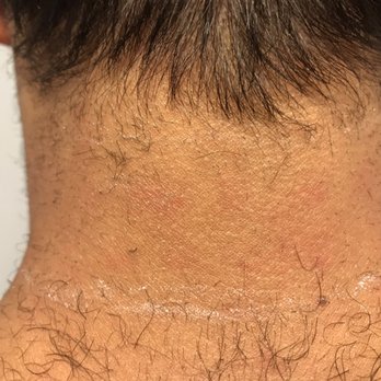 Men S Laser Neck Hair Removal Yelp