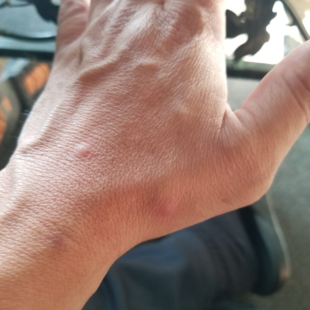 Colonial Motel - Bed bug bites and the owners would not make it right. Stay away!! - Hotels Near Me - Lima, Ohio
