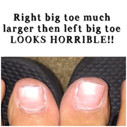 My right toe nail is significantly longer then left nail. It looks horrible. This is after I asked her to cut it down twice: My right toe nail is significantly longer then left nail. It looks horrible. This is after I asked her to cut it down twice: