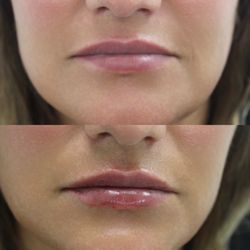 Luminance Aesthetics - Fixing asymmetries and plumping her lips.