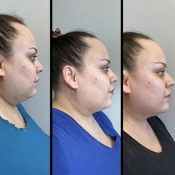 Body Sculpting Scv - Neck sculpting