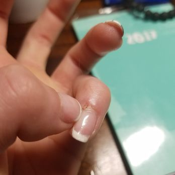 Nail Focus - As you can see she cut my cuticles to short and made them bleed like they do everybody else. - Nail Salons Near Me - Littleton, Colorado Nail Focus - As you can see she cut my cuticles to short and made them bleed like they do everybody else. - Nail Salons Near Me - Littleton, Colorado