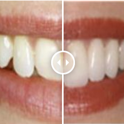 Acadian Family Dental - Dental Veneers