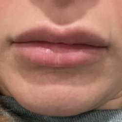 My lips after injection