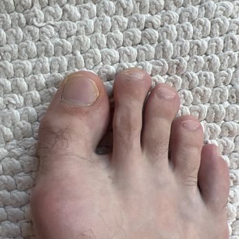 Lexi Nails - Right toe pedicure. Same yellowing of nails - Nail Salons Near Me - Minneapolis, Minnesota Lexi Nails - Right toe pedicure. Same yellowing of nails - Nail Salons Near Me - Minneapolis, Minnesota
