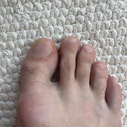 Lexi Nails - Right toe pedicure. Same yellowing of nails