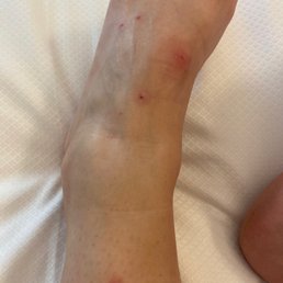 Just a small area of the bites I got from the bed bugs!
