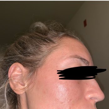 AH Laser Aesthetics - Day of procedure - Laser Hair Removal Near Me - Arlington Heights, Illinois