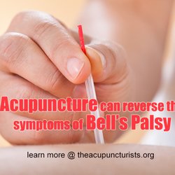 The Acupuncturists - Acupuncture can help relieve the symptoms of Bells' Palsy quickly and effectively