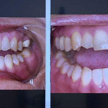 TruDental - Look at how straight they are now!! - General Dentistry Near Me - Cypress, California TruDental - Look at how straight they are now!! - General Dentistry Near Me - Cypress, California