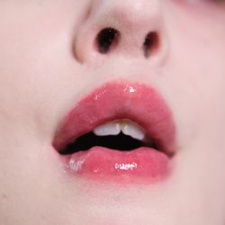 Jagged, botched lip filler