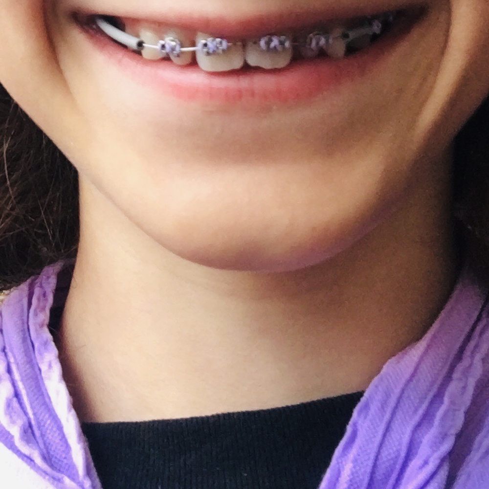 VCU Dental Care Student Practice - Lavender bands for the little lady - Orthodontists Near Me - Richmond, Virginia VCU Dental Care Student Practice - Lavender bands for the little lady - Orthodontists Near Me - Richmond, Virginia
