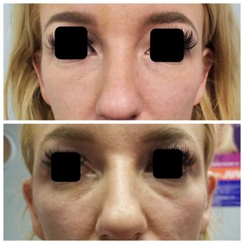 Fusion Medispa - Tighten the skin around the eyes - Medical Spas Near Me - Odessa, Florida Fusion Medispa - Tighten the skin around the eyes - Medical Spas Near Me - Odessa, Florida
