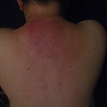 Downtown Massage - You can see the bruising down my spine and all over the top of my back thanks to Peter! I never had this happen with ANY massage anywhere! - Massage Near Me - Albuquerque, New Mexico Downtown Massage - You can see the bruising down my spine and all over the top of my back thanks to Peter! I never had this happen with ANY massage anywhere! - Massage Near Me - Albuquerque, New Mexico