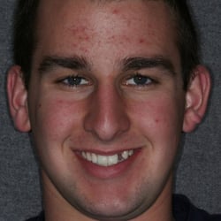 Castro Valley Dental Care - Michael K before a mini implant was placed.