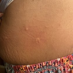New Braunfels Leasing & Property Management - More bed bug bites.