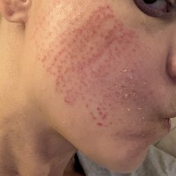 Najia's Skincare & Laser Center - Face laser
