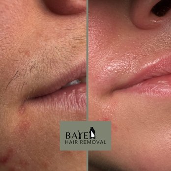 Bare Hair Removal - Upper lip progress - Laser Hair Removal Near Me - Broomfield, Colorado Bare Hair Removal - Upper lip progress - Laser Hair Removal Near Me - Broomfield, Colorado
