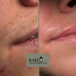 Bare Hair Removal - Upper lip progress