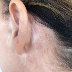 Gregory S Keller, MD FACS - Left ear scarring in back.