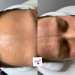 A Touch By Mel - Skin Tightening