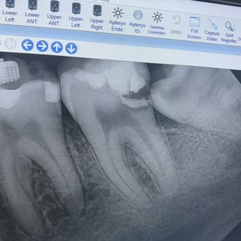 Surfside Dental - After Dr.McMahan drilled a hole into the tooth - General Dentistry Near Me - Oceanside, California Surfside Dental - After Dr.McMahan drilled a hole into the tooth - General Dentistry Near Me - Oceanside, California