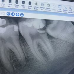 After Dr.McMahan drilled a hole into the tooth