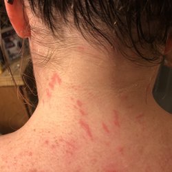 Hand & Stone Massage and Facial Spa - Results of my "massage"
