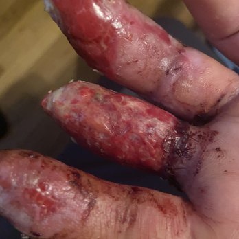 Selective Rehab - Right hand finger injury needing skin graft - Physical Therapy Near Me - Newport Beach, California Selective Rehab - Right hand finger injury needing skin graft - Physical Therapy Near Me - Newport Beach, California