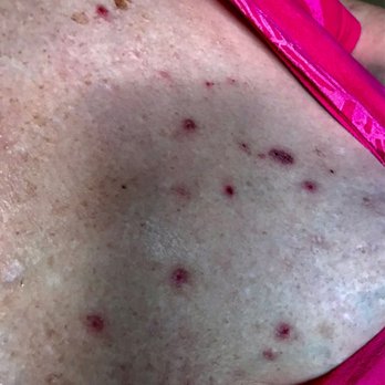 Summit Plastic Surgery & Dermatology - Pictures of skin might infestations that Kristen did not see - Dermatologists Near Me - Wilmington, North Carolina Summit Plastic Surgery & Dermatology - Pictures of skin might infestations that Kristen did not see - Dermatologists Near Me - Wilmington, North Carolina