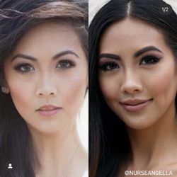 Nurse Angella - Before and after lip fillers