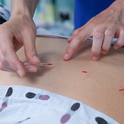 Bedford Acupuncture - Acupuncture treatment