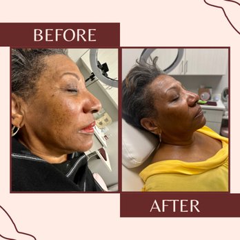B Whole Cosmetic Aesthetics - Microneedling with PRP- 2 sessions - Medical Spas Near Me - Plano, Texas B Whole Cosmetic Aesthetics - Microneedling with PRP- 2 sessions - Medical Spas Near Me - Plano, Texas