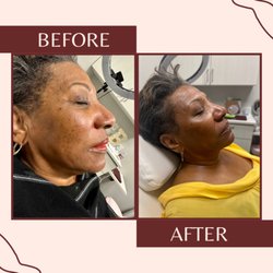 B Whole Cosmetic Aesthetics - Microneedling with PRP- 2 sessions