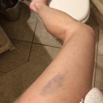 Spa at the Woods - Giant bruise from my "massage" - Day Spas Near Me - Killington, Vermont Spa at the Woods - Giant bruise from my "massage" - Day Spas Near Me - Killington, Vermont
