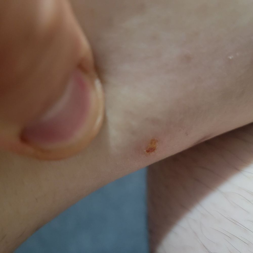 Low Price Auto Glass - Flea bites after visiting their business - Auto Glass Services Near Me - Wilmington, California Low Price Auto Glass - Flea bites after visiting their business - Auto Glass Services Near Me - Wilmington, California