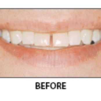 Leonard M. Kaplan, DDS - Spaced Teeth- Before - General Dentistry Near Me - Greensboro, North Carolina Leonard M. Kaplan, DDS - Spaced Teeth- Before - General Dentistry Near Me - Greensboro, North Carolina