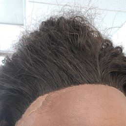 This is what my hairline looked like after the stylist tried her best This is what my hairline looked like after the stylist tried her best