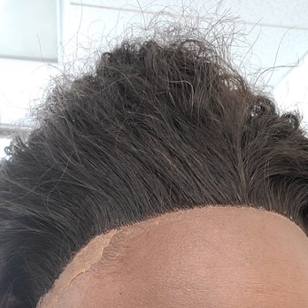 Sunny's Hair & Wigs - This is what my hairline looked like after the stylist tried her best - Hair Extensions Near Me - Mesa, Arizona Sunny's Hair & Wigs - This is what my hairline looked like after the stylist tried her best - Hair Extensions Near Me - Mesa, Arizona