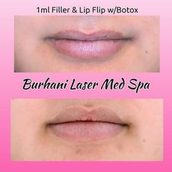 Lip filler & Smooth Collagen threads around vermillion border