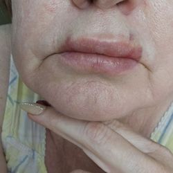 Texas Laser Institute - Next day... (sigh)