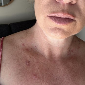 Oceana Dermatology - This is one hour after skin tags removal - Dermatologists Near Me - Carlsbad, California Oceana Dermatology - This is one hour after skin tags removal - Dermatologists Near Me - Carlsbad, California