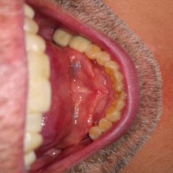Pacific Dental Centre - 4 missing teeth. Dr.Jack Gardner.